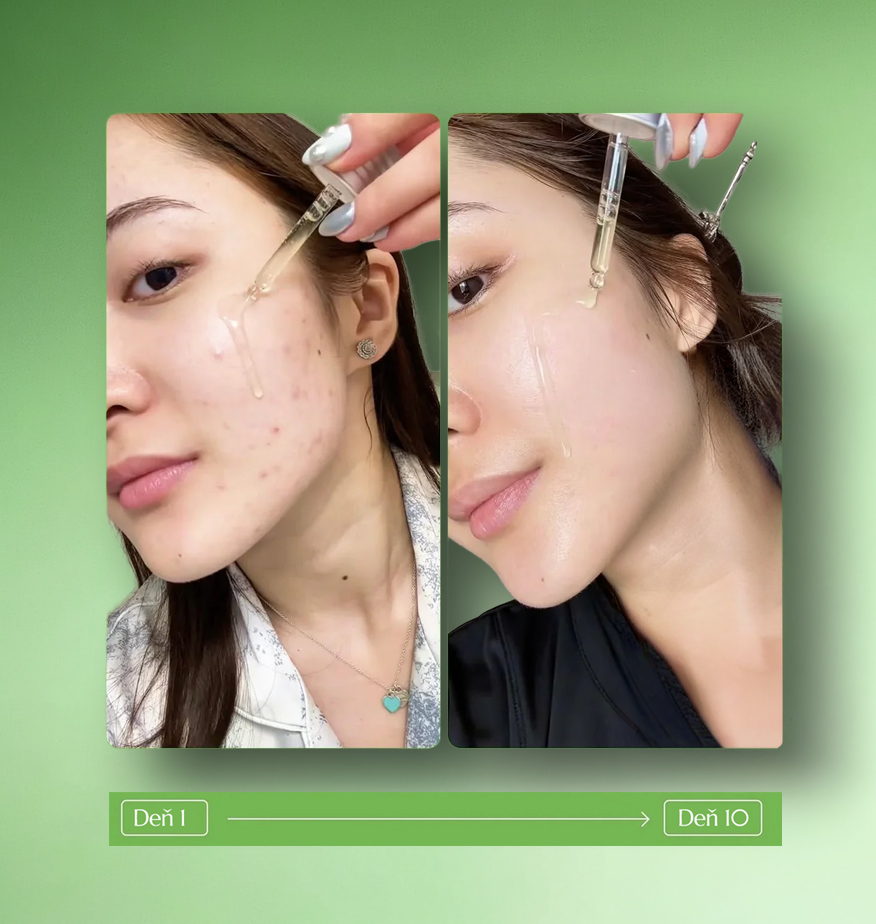 Anua Azelaic Acid 10 Hyaluron detail produktu